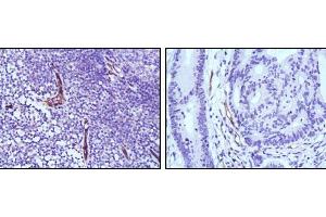 Immunohistochemical analysis of paraffin-embedded human lymph node (left) and colon cancer (right) tissues using eNOS mouse mAb with DAB staining. (ENOS antibody)