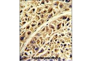 Formalin-fixed and paraffin-embedded human hepatocarcinoma with PRELP Antibody (C-term), which was peroxidase-conjugated to the secondary antibody, followed by DAB staining. (PRELP antibody  (C-Term))