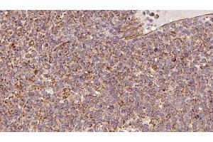 ABIN6273183 at 1/100 staining Human lymph cancer tissue by IHC-P. (UQCRC2 antibody  (Internal Region))