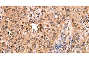 Immunohistochemistry of paraffin-embedded Human lung cancer using ACO2 Polyclonal Antibody at dilution of 1:30 (ACO2 antibody)