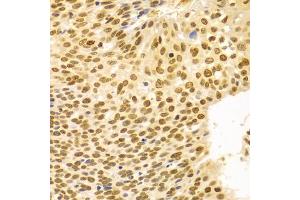 Immunohistochemistry of paraffin-embedded human esophageal cancer using DKC1 Antibody (ABIN5970956) at dilution of 1/100 (40x lens). (DKC1 antibody)