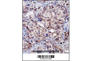 RNF144A Antibody immunohistochemistry analysis in formalin fixed and paraffin embedded human breast carcinoma followed by peroxidase conjugation of the secondary antibody and DAB staining. (RNF144A antibody  (AA 156-184))