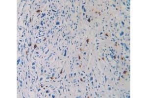 IHC-P analysis of Human Stomach Cancer Tissue, with DAB staining. (TPSAB1 antibody  (AA 161-262))