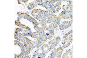 Immunohistochemistry of paraffin-embedded human liver cancer using ATPIF1 antibody.