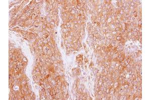 IHC-P Image Immunohistochemical analysis of paraffin-embedded BT474 xenograft, using GMF beta, antibody at 1:500 dilution. (GMFB antibody)