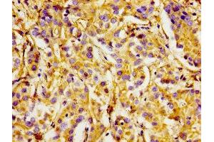 Immunohistochemistry of paraffin-embedded human liver cancer using ABIN7156425 at dilution of 1:100 (Integrin alpha 1 antibody  (AA 242-524))
