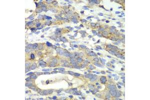 Immunohistochemistry of paraffin-embedded human gastric cancer using CHMP2B antibody. (CHMP2B antibody)