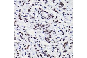 Immunohistochemistry of paraffin-embedded human gastric cancer using H3K18ac antibody (ABIN7267668) at dilution of 1:100 (40x lens). (Histone 3 antibody  (H3K18))