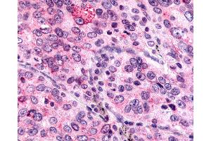 Anti-MRGPRX4 / MRGX4 antibody IHC of human Lung, Non-Small Cell Carcinoma.