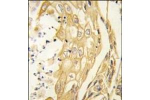 Formalin-fixed and paraffin-embedded human lung carcinoma tissue reacted with the EphB4 antibody, which was peroxidase-conjugated to the secondary antibody, followed by DAB staining. (EPH Receptor B4 antibody)