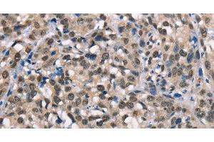 Immunohistochemistry of paraffin-embedded Human esophagus cancer using NSMCE3 Polyclonal Antibody at dilution of 1:40 (Necdin-Like 2 antibody)