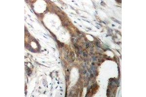 Immunohistochemical analysis of ASCT1 staining in human ovarian cancer formalin fixed paraffin embedded tissue section. (SLC1A4 antibody)