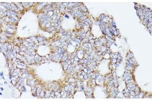 Immunohistochemistry of paraffin-embedded Human colon carcinoma using ACAT2 Polyclonal Antibody at dilution of 1:100 (40x lens). (ACAT2 antibody)