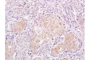 Formalin-fixed and paraffin embedded human endometrial cancer labeled with Anti-phospho-CDKN1A/P21 (Thr57) Polyclonal Antibody, Unconjugated (ABIN756877) followed by conjugation to the secondary antibody and DAB staining (p21 antibody  (pThr57))