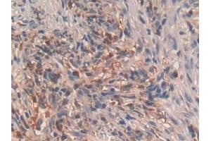 Detection of GHRH in Human Lung cancer Tissue using Polyclonal Antibody to Growth Hormone Releasing Hormone (GHRH) (GHRH antibody  (AA 19-108))