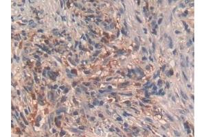 Detection of GHRH in Human Lung cancer Tissue using Polyclonal Antibody to Growth Hormone Releasing Hormone (GHRH)