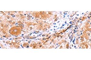 Immunohistochemistry of paraffin-embedded Human liver cancer tissue using IRGC Polyclonal Antibody at dilution of 1:30(x200) (IRGC antibody)