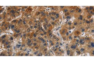 Immunohistochemistry of paraffin-embedded Human liver cancer tissue using Claudin 8 Polyclonal Antibody at dilution 1:50 (CLDN8 antibody)