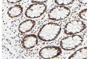 ABIN6267330 at 1/200 staining human colon carcinoma tissue sections by IHC-P. (HNRNPC antibody  (pSer260))