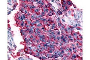 Anti-GPR63 antibody IHC of human Lung, Non-Small Cell Carcinoma. (GPR63 antibody  (Cytoplasmic Domain))