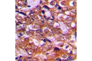 Immunohistochemical analysis of RPS12 staining in human prostate cancer formalin fixed paraffin embedded tissue section. (RPS12 antibody  (C-Term))