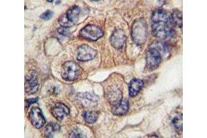IHC analysis of FFPE human hepatocarcinoma tissue stained with PDGFR antibody (PDGFRA antibody  (AA 698-727))