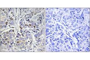 Immunohistochemistry analysis of paraffin-embedded human breast carcinoma tissue, using Centromeric Protein A (Ab-7) Antibody. (CENPA antibody  (AA 1-50))