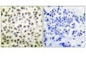 Immunohistochemical analysis of paraffin-embedded human colon carcinoma tissue using STAT5B (Ab-731) antibody. (STAT5B antibody  (Ser731))