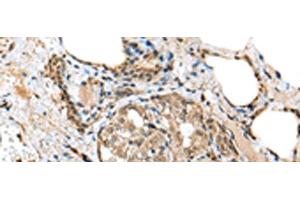 Immunohistochemistry of paraffin-embedded Human thyroid cancer tissue using TPPP Polyclonal Antibody at dilution of 1:25(x200) (Tppp antibody)