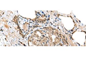 Immunohistochemistry of paraffin-embedded Human thyroid cancer tissue using TPPP Polyclonal Antibody at dilution of 1:25(x200) (Tppp antibody)