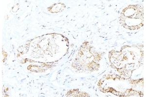 ABIN6276306 at 1/100 staining Human lung cancer tissue by IHC-P. (Cytochrome C antibody  (N-Term))