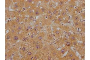 IHC image of ABIN7144415 diluted at 1:200 and staining in paraffin-embedded human liver cancer performed on a Leica BondTM system. (APOC1 antibody  (AA 35-48))
