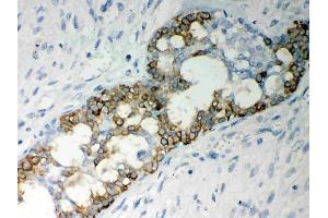 Anti-Caspase-7 Picoband antibody, (ABIN3042355),IHC(P)IHC(P): Human Mammary Cancer Tissue (Caspase 7 antibody  (AA 117-198))