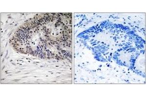 Immunohistochemistry analysis of paraffin-embedded human colon carcinoma, using MDM4 (Phospho-Ser367) Antibody. (MDM4-binding Protein antibody  (pSer367))