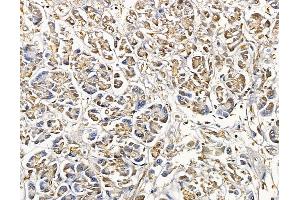 ABIN6265341 and ABIN6279794 at 1/100 staining human pancreatic cancer by IHC-P. (STK25 antibody  (Internal Region))