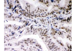 Anti- DAXX Picoband antibody,IHC(P) IHC(P): Human Intestinal Cancer Tissue (DAXX antibody  (AA 56-345))