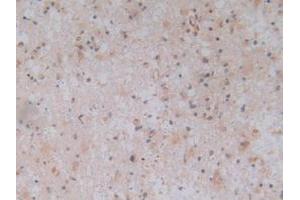 IHC-P analysis of Human Glioma Tissue, with DAB staining. (TLR9 antibody  (AA 28-362))