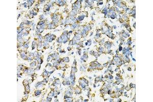 Immunohistochemistry of paraffin-embedded Human lung cancer using ADSS Polyclonal Antibody at dilution of 1:100 (40x lens). (ADSS antibody)