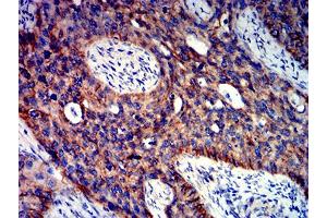 Immunohistochemical analysis of paraffin-embedded cervical cancer tissues using CTNNB1 mouse mAb with DAB staining.