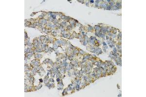 Immunohistochemistry of paraffin-embedded human esophageal cancer using PI3 antibody (ABIN6293676) at dilution of 1:100 (40x lens). (PI3 antibody)