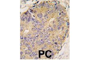 Formalin-fixed and paraffin-embedded human prostate carcinoma tissue reacted with BMP15 polyclonal antibody  , which was peroxidase-conjugated to the secondary antibody, followed by DAB staining. (BMP15 antibody  (Internal Region))