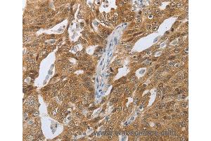 Immunohistochemistry of Human ovarian cancer using CEBPA Polyclonal Antibody at dilution of 1:40 (CEBPA antibody)