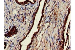 Immunohistochemistry of paraffin-embedded human prostate cancer using ABIN7147854 at dilution of 1:100 (CLINT1 antibody  (AA 1-625))