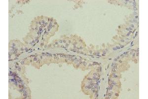 Immunohistochemistry of paraffin-embedded human prostate cancer using ABIN7157054 at dilution of 1:100 (ISCA2 antibody  (AA 9-154))