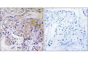 Immunohistochemistry analysis of paraffin-embedded human breast carcinoma tissue, using ULK3 Antibody.