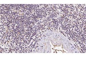 ABIN6273050 at 1/100 staining Human lymph cancer tissue by IHC-P. (IFT52 antibody  (Internal Region))