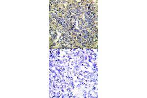 Immunohistochemical staining (Formalin-fixed paraffin-embedded sections) of human lung cancer tissue with CASP9 (phospho T125) polyclonal antibody  without blocking peptide (A) or preincubated with blocking peptide (B) under 1:50-1:100 dilution. (Caspase 9 antibody  (pThr125))