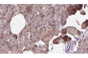 ABIN6273269 at 1/100 staining Human pancreas cancer tissue by IHC-P. (MTHFD1L antibody  (C-Term))