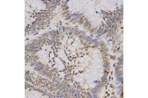 Immunohistochemistry of paraffin-embedded human rectal cancer using TriMethyl-Histone H3-K79 antibody. (Histone 3 antibody  (H3K79me3))