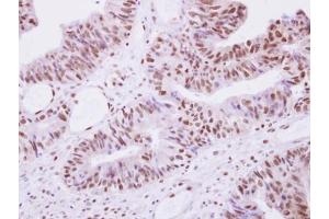 IHC-P Image Selenophosphate synthetase 1 antibody detects SEPHS1 protein at nucleus on human colon carcinoma by immunohistochemical analysis. (SEPHS1 antibody)